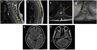 Cryptococcal infection causing longitudinal extensive transverse myelitis in an immunocompetent individual: Case report and literature review